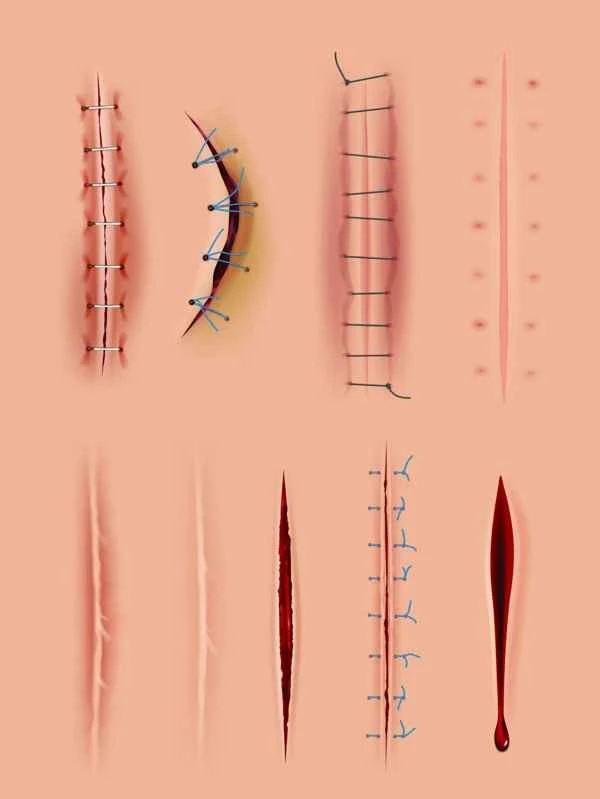 How to remove cesarean section scars