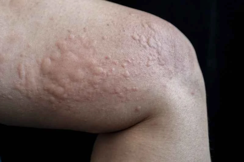 What is acute urticaria and what causes it?