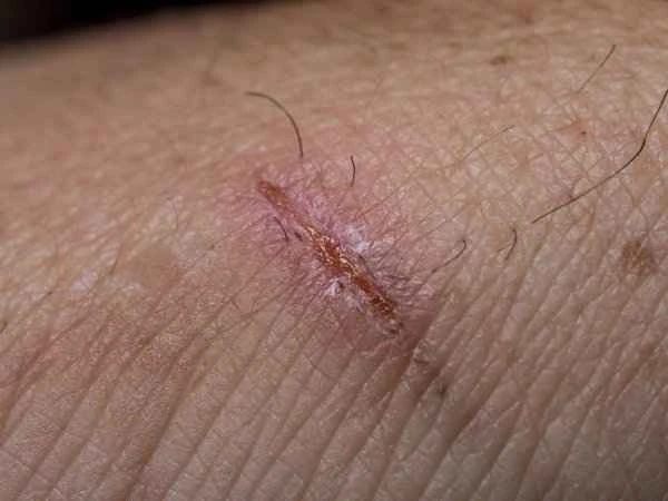 How long does it take for a cut scar to stabilize?