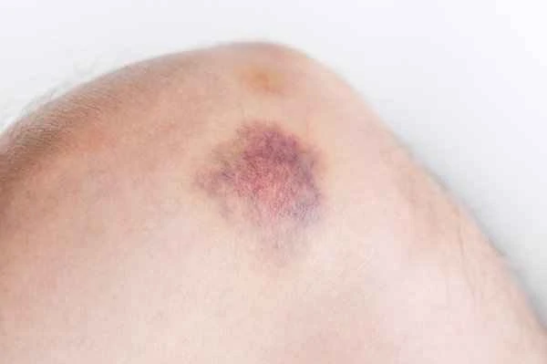 Are bruises a type of scar and how are they treated?