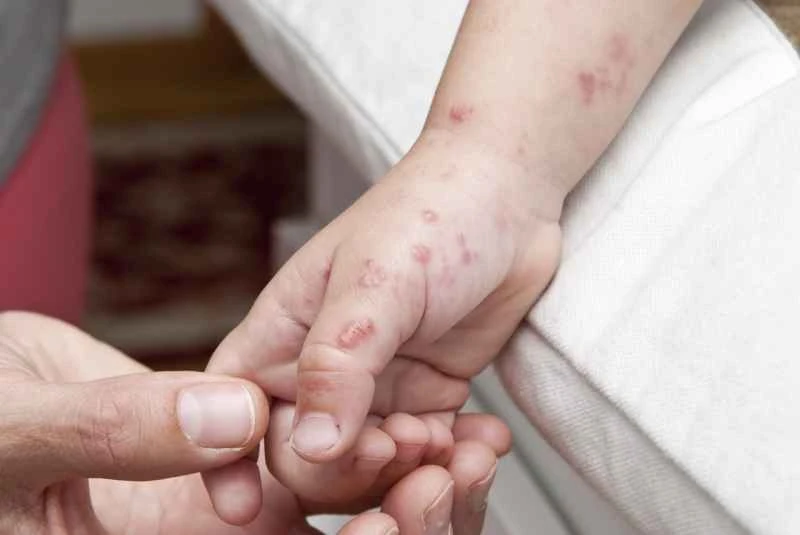 What causes urticaria in children?