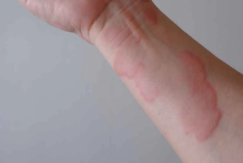 What medicine can cure urticaria?