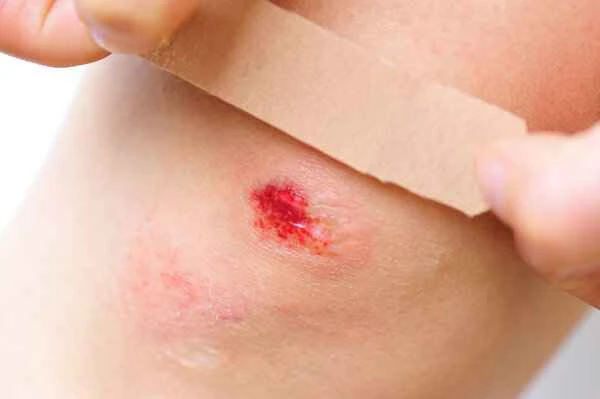 Are bruises a type of scar and how are they treated?