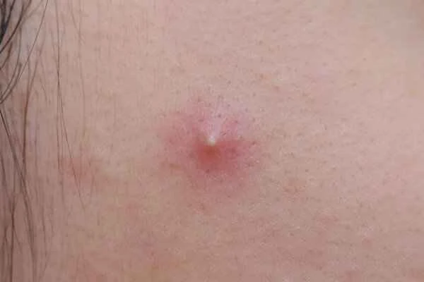 How to remove acne scars and keloids