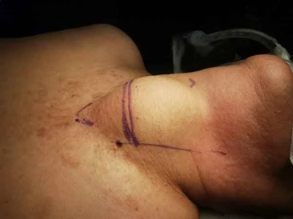 How to release nerve compression caused by scar tissue after a facelift?