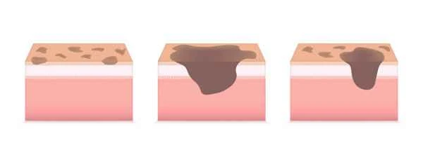 How to repair a damaged skin barrier on the face