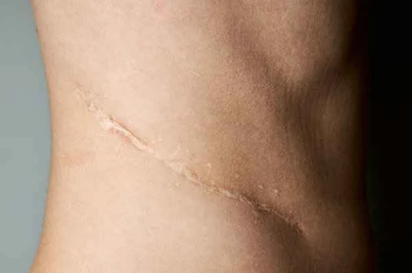 How long does it take for keloid scars to heal after repair?