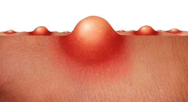 Small white bumps on the hair follicles of the scrotum