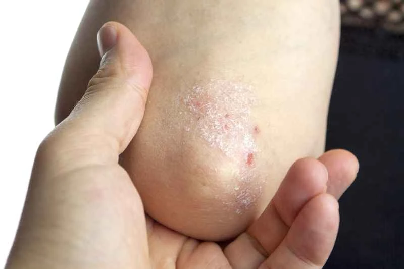 Can psoriasis be completely cured?