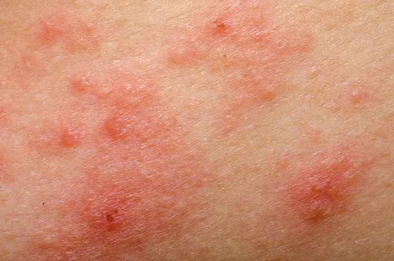What to do if eczema keeps recurring for months?