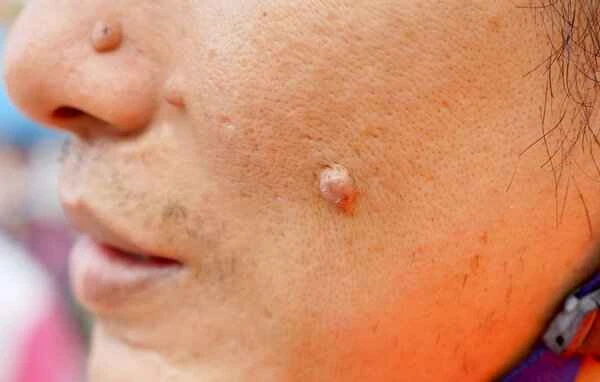What can I do about keloid scars on my face?