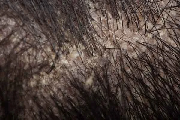 How to improve seborrheic dermatitis of the scalp