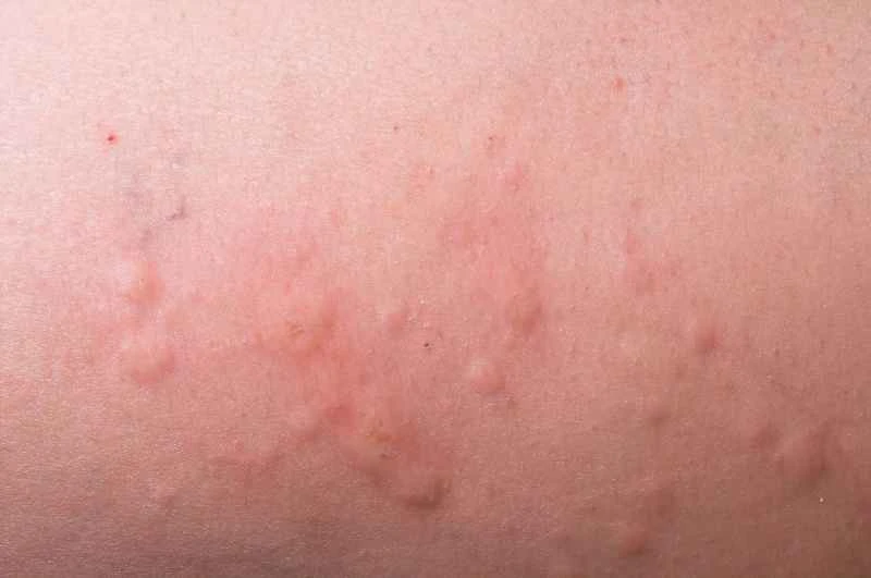 Can papular urticaria be life-threatening?