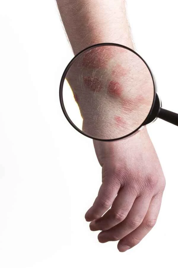 Can scrotal eczema and psoriasis heal on their own?