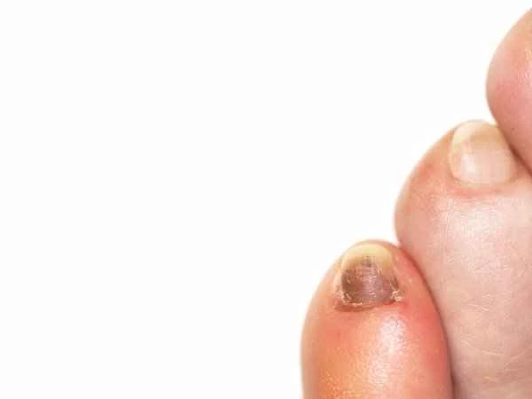 What causes fingernails to turn slightly black?