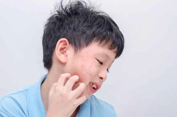 Itching persists for months after being bitten by an insect