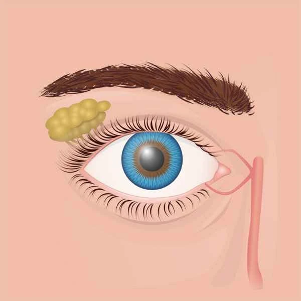 How to remove scars left on the eyeball