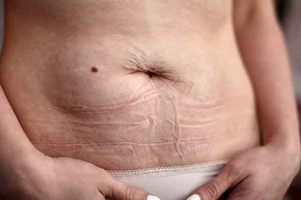 How to treat electroconvulsive therapy scars?