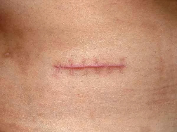 How to treat laceration scars