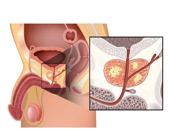 What to do about severe pain from scrotal folliculitis?