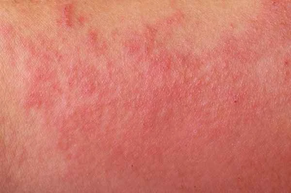 Can eczema be cured completely?