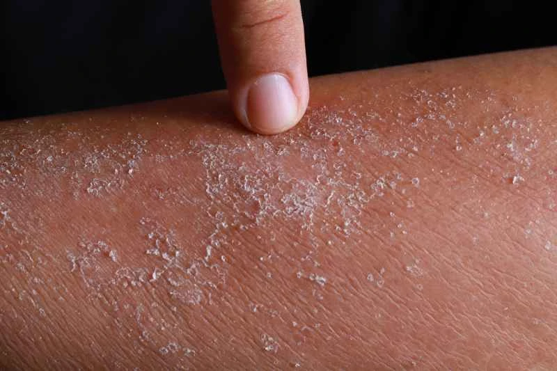 Is eczema in children contagious?