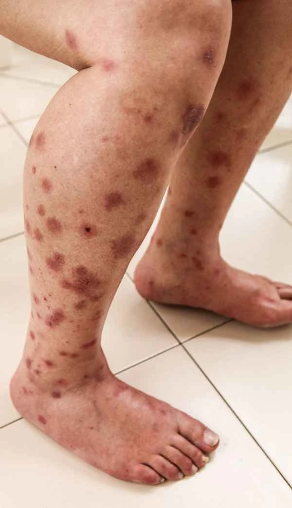 Why do I have small purple spots on my legs?