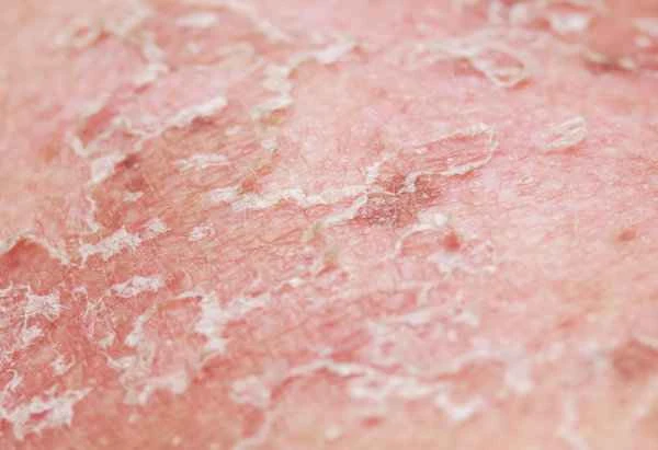 Why is there dandruff on the surface of my hair?