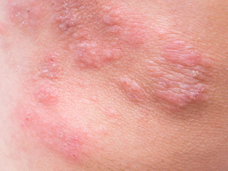 Is generalized eczema contagious?