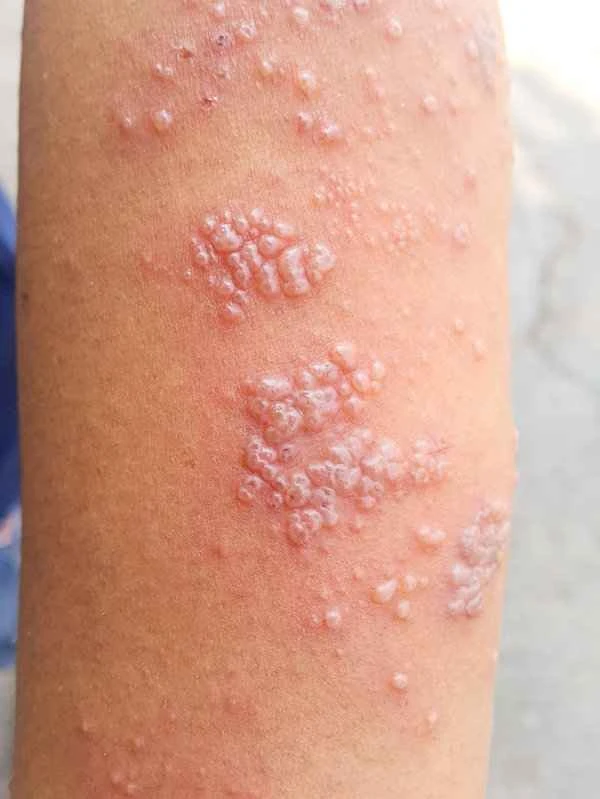 How many items are included in a skin allergy test?