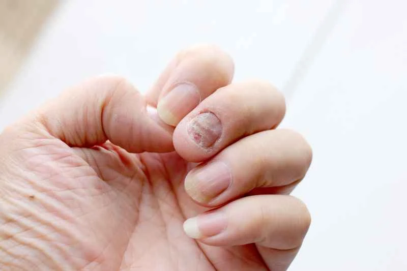 What ointment is used for nail psoriasis?