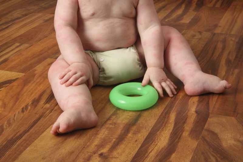 What causes postpartum urticaria and how can it be cured?