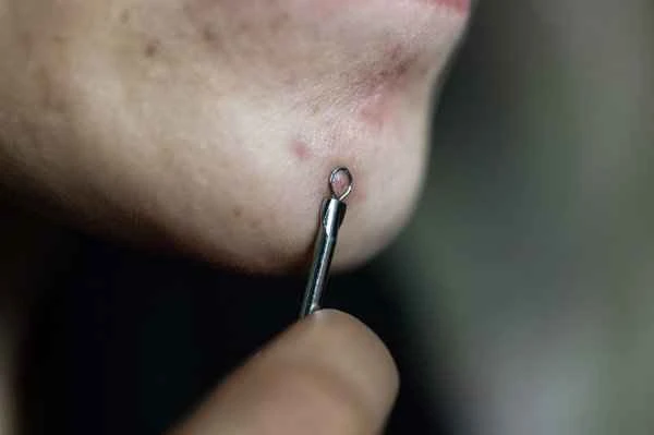 How to treat scars on the jawline?