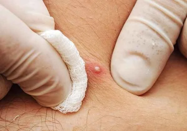 How to treat keloids