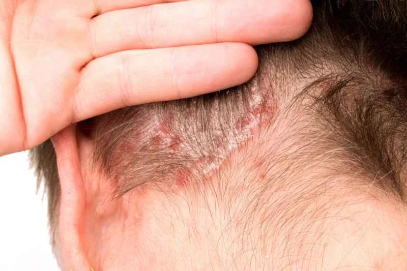 How to cure psoriasis completely using traditional Chinese medicine?