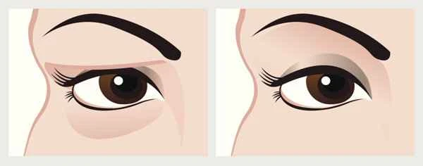 How long is the scar hyperplasia period after eyelid surgery?