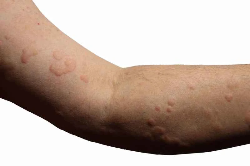 Can artificial urticaria be cured?