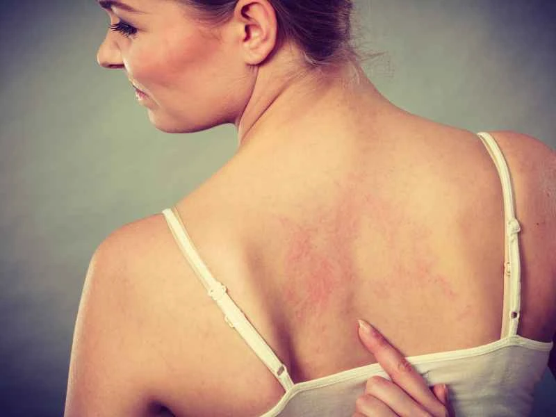 Can urticaria cause delayed menstruation and how is it treated?