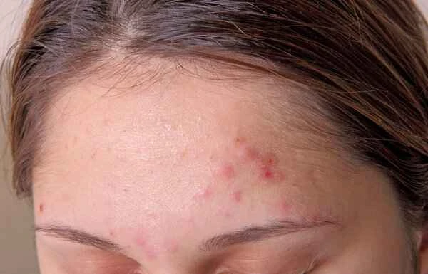How to treat pimple scars caused by picking at them?
