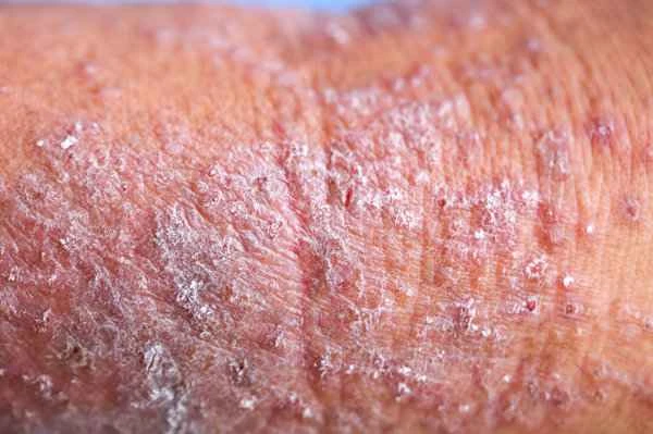 Does having eczema all over your body indicate a blood problem?