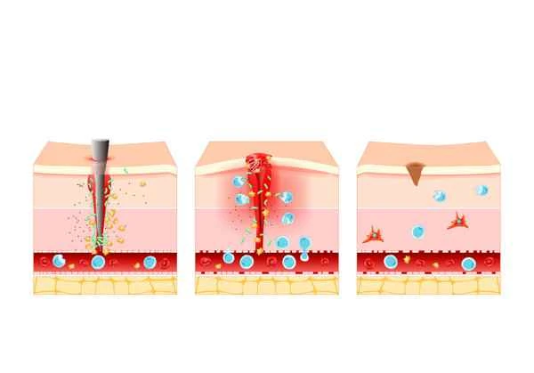 How to promote the fastest scar healing