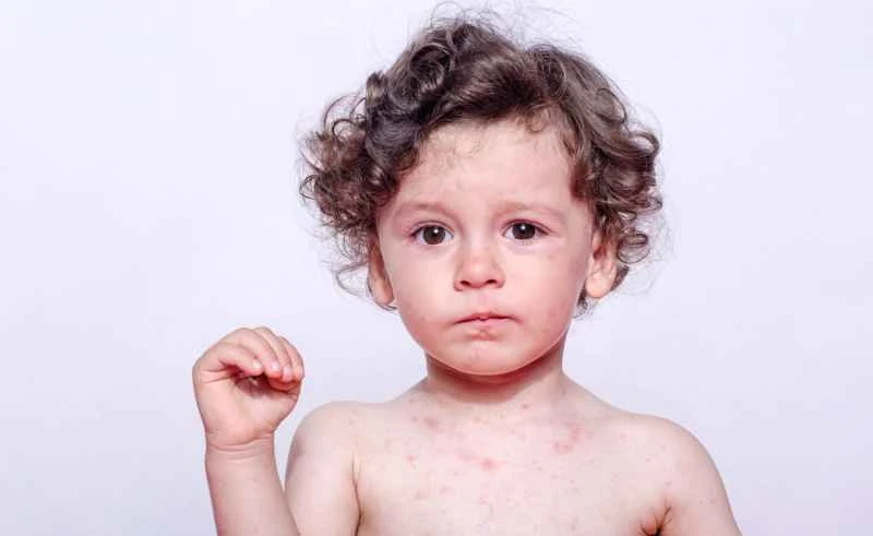 Is eczema in children contagious?