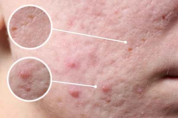 How to care for acne scars