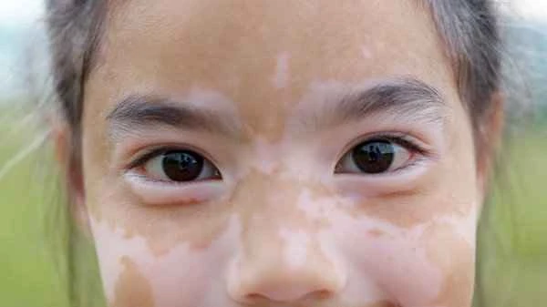 How to care for skin if you have vitiligo on your face