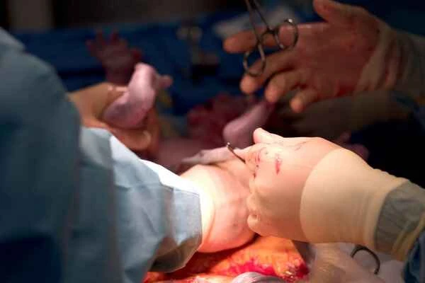 What to do about keloid scarring after a C-section?