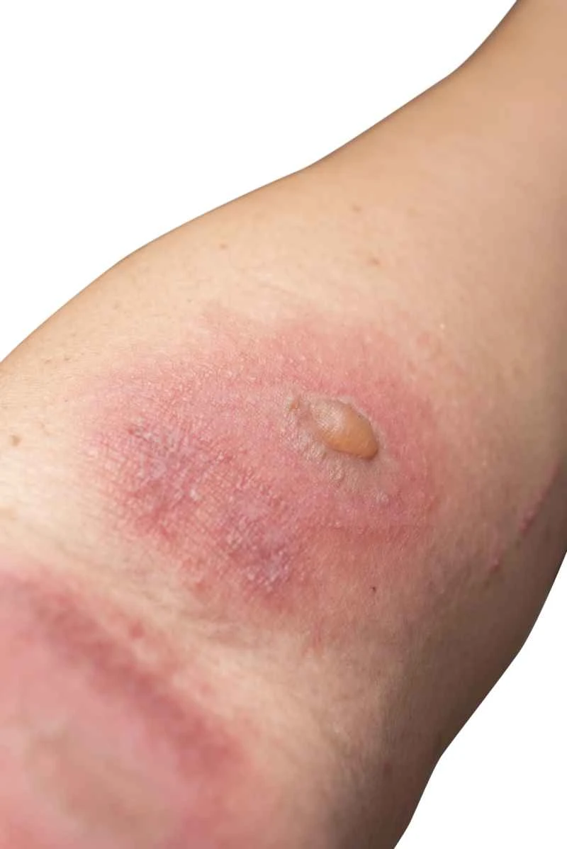 Is dermatitis/eczema contagious?