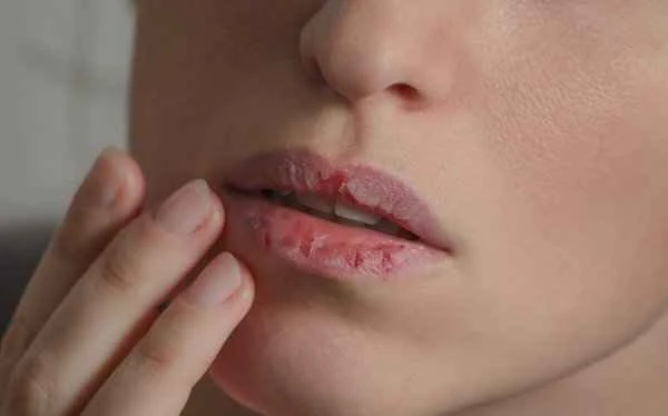 Can La Mer lip balm treat cheilitis?