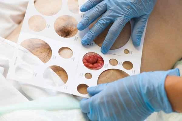 How to measure the thickness of keloid scars