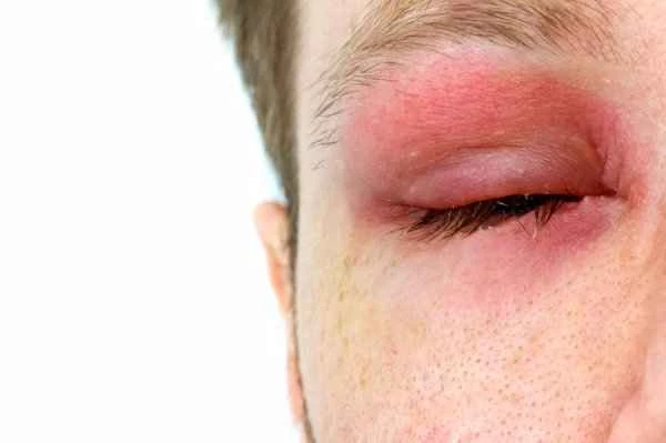 What should I do if my hand swells up after being stung by a bee?