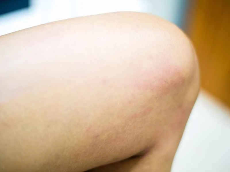 Which department should I go to for acute urticaria?